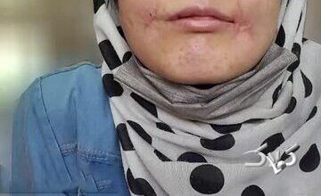 مرد مشهدی لبهای زن ۱۸ سالهاش را دوخت / فائزه به کلانتری پناه برد/ عکس