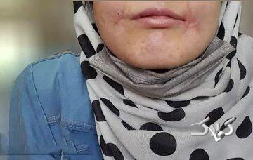 مرد مشهدی لبهای زن ۱۸ سالهاش را دوخت / فائزه به کلانتری پناه برد/ عکس