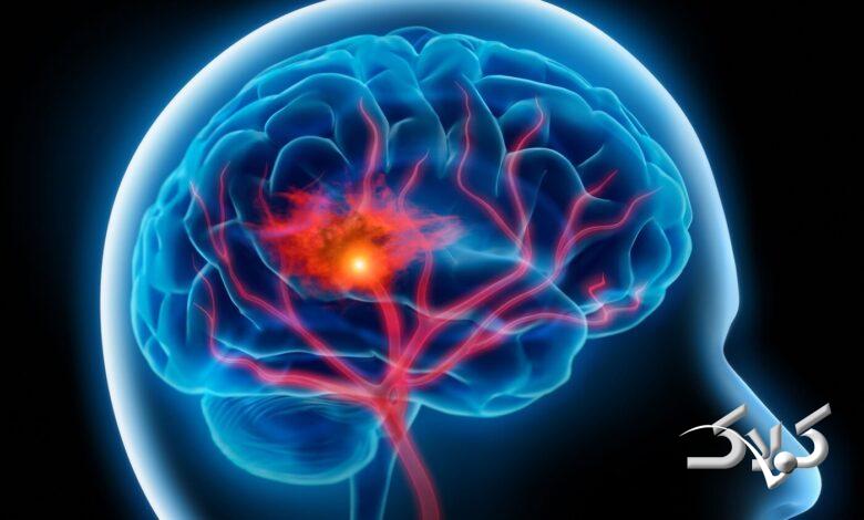 دلیل شکست درمان پیشگیرانه برای سکته مغزی چیست؟