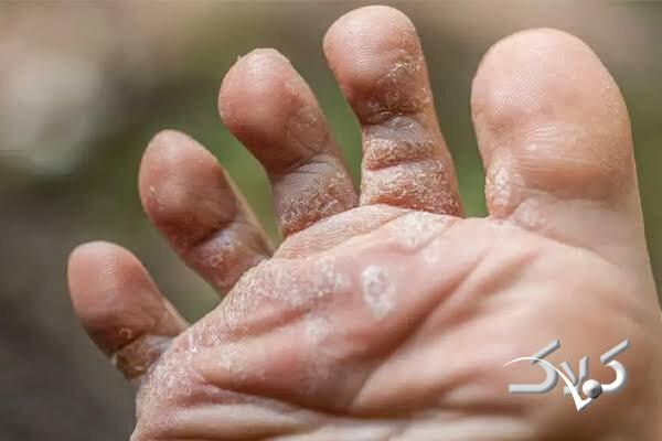 پوسته شدن پا